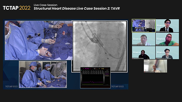 Structural Heart Disease Live Case Session 2: TAVR			