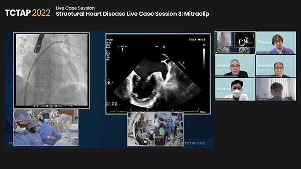 Structural Heart Disease Live Case Session 3: Mitraclip		