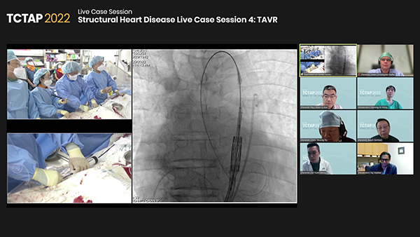 Structural Heart Disease Live Case Session 4: TAVR