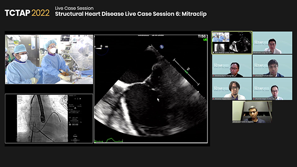 Structural Heart Disease Live Case Session 6: Mitraclip