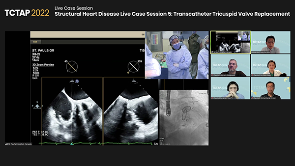 Structural Heart Disease Live Case Session 5: Transcatheter Tricuspid Valve Replacement