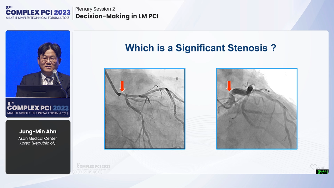 Plenary Session 2: Decision-Making in LM PCI