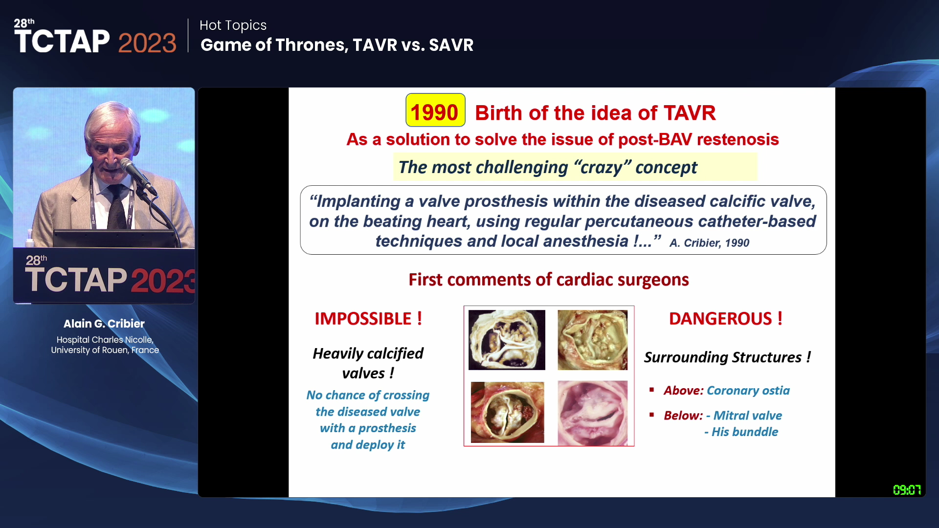 [Hot Topics] Game of Thrones, TAVR vs. SAVR