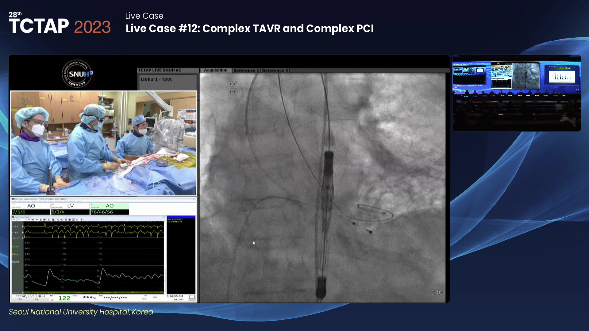 Live Case #12: Complex TAVR and Complex PCI