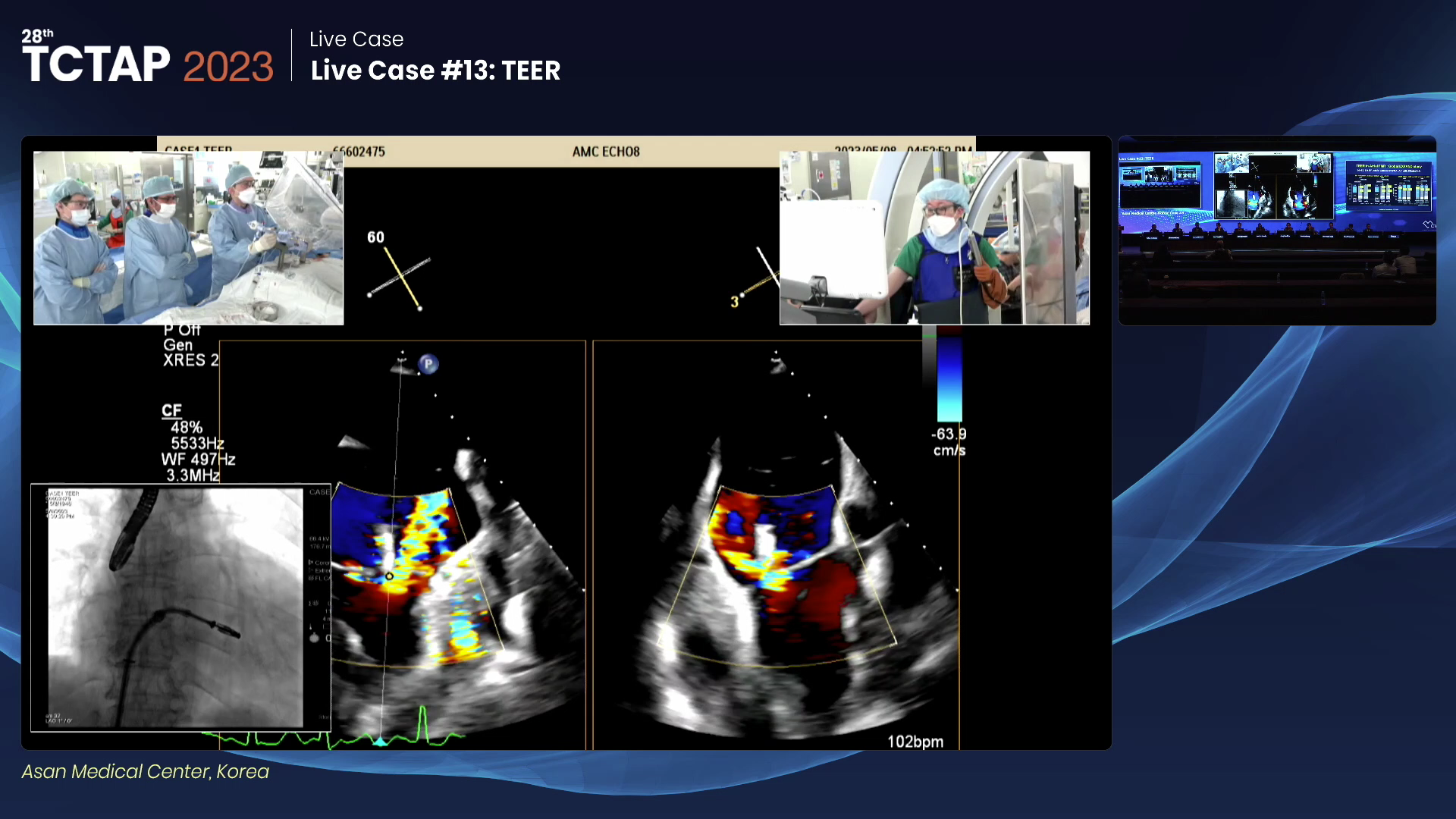 Live Case #13: TEER