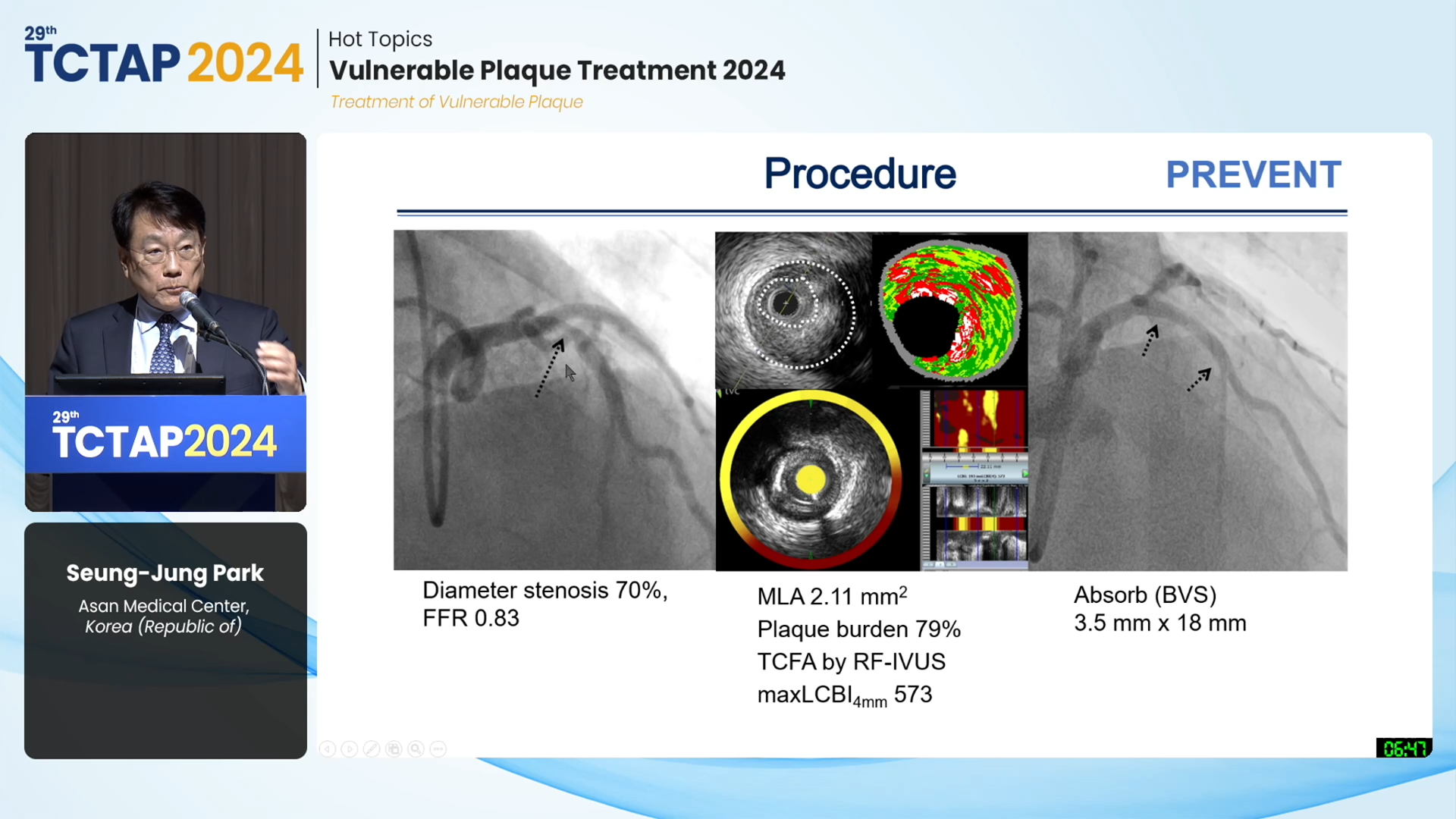 [Hot Topics] Vulnerable Plaque Treatment 2024