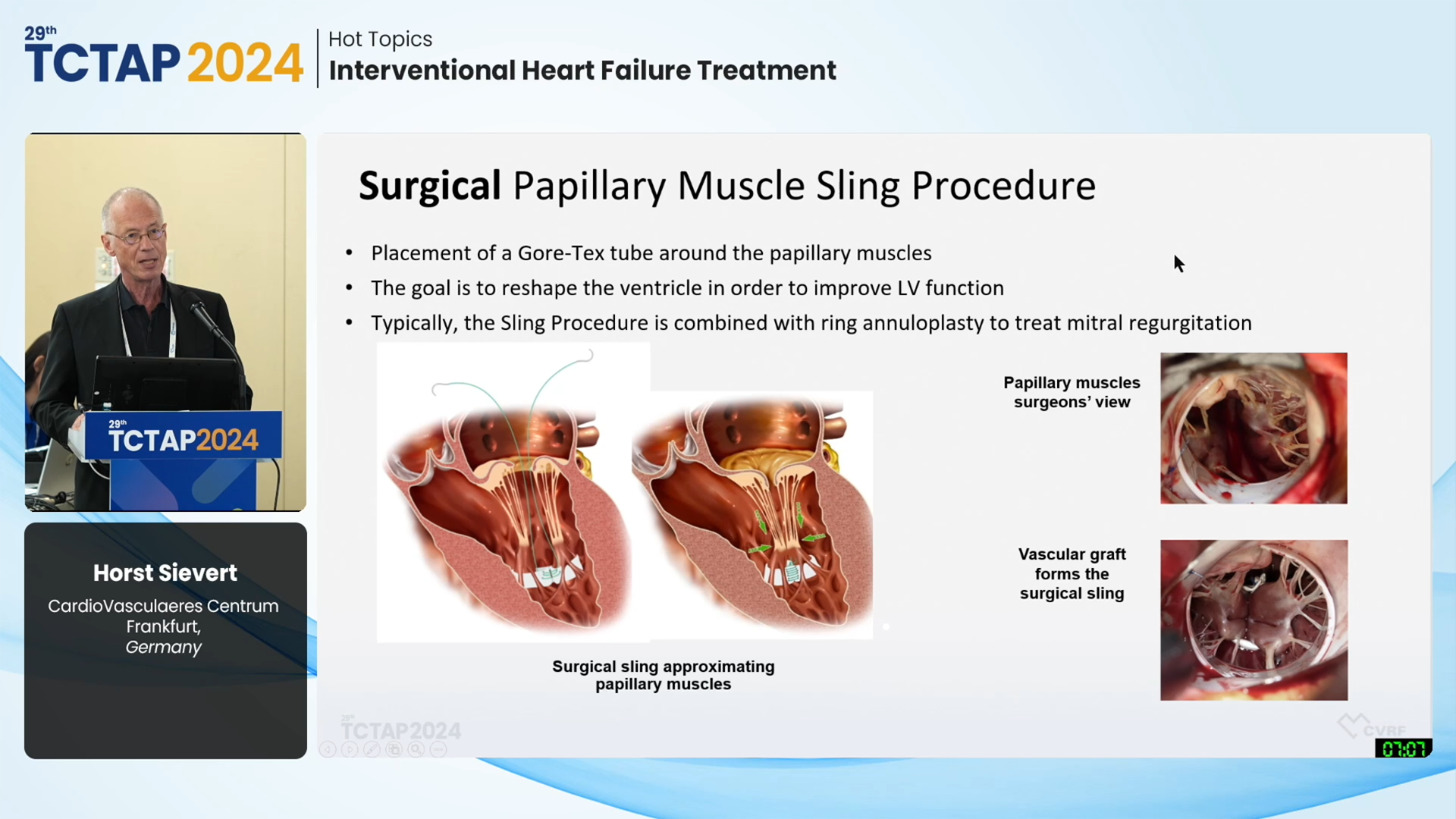 [Hot Topics] Interventional Heart Failure Treatment