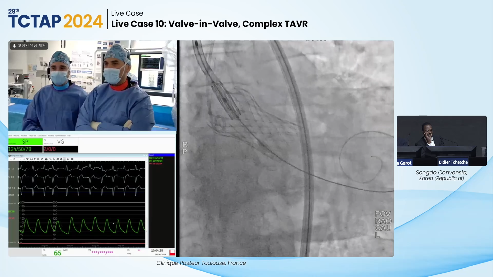 Live Case 10: Valve-in-Valve, Complex TAVR 