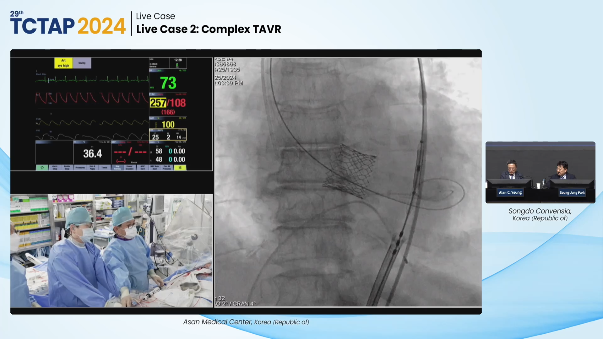 Live Case 2: Complex TAVR